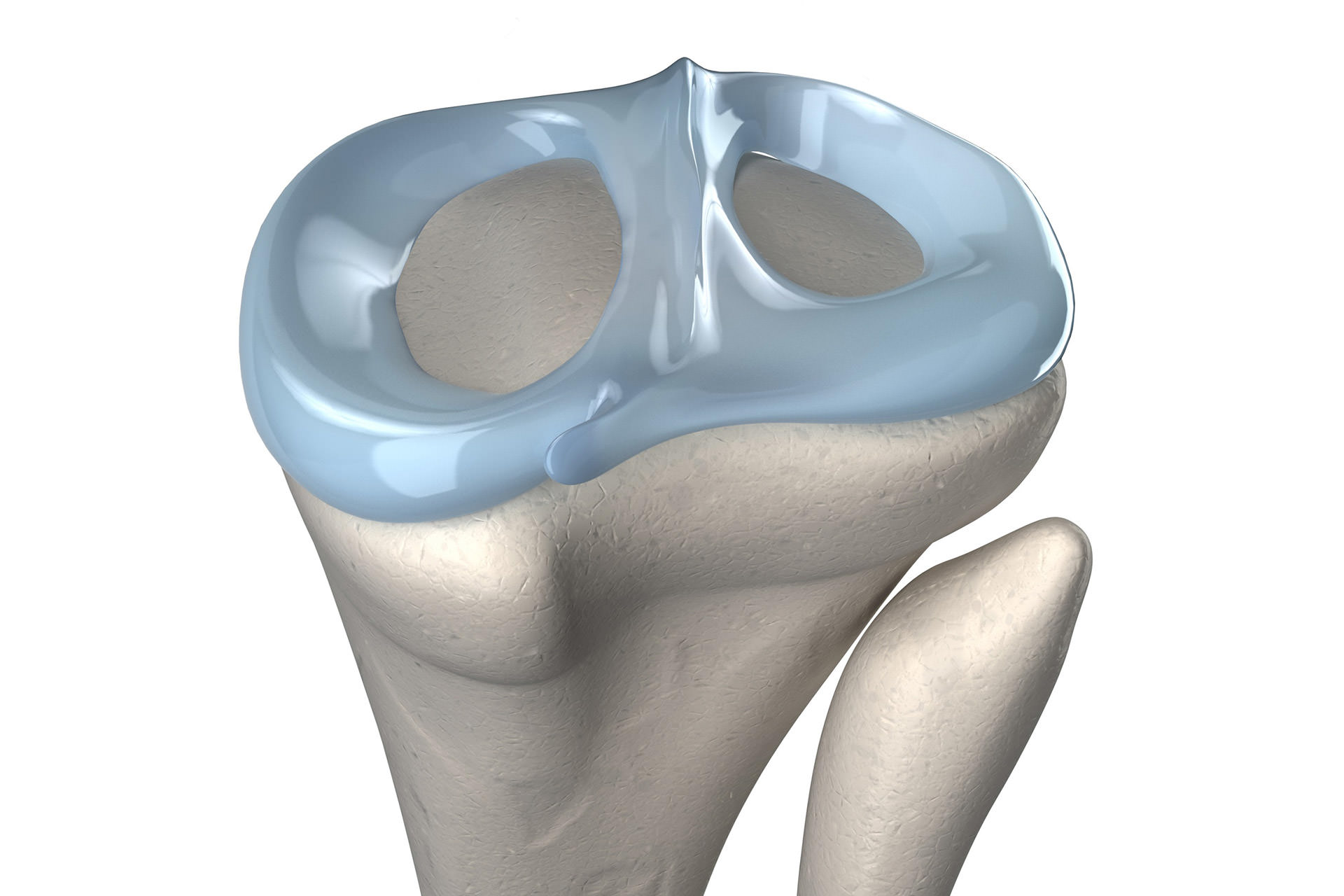 Meniscos Ortotrauma